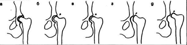 Реферат: Симптомы дисплазии тазобедренных суставов